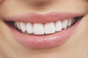 Closeup of smile with porcelain veneers
