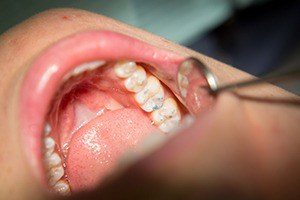 Closeup of smile during metal free dental restoration placement