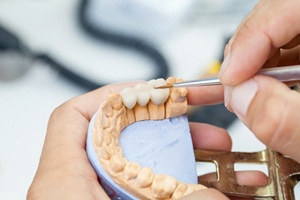 dentist in West Monroe designing a dental bridge