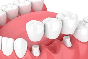 traditional dental bridge being placed