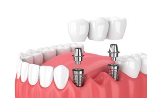 implant bridge being placed