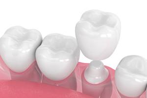 Image of dental crown in West Monroe, LA being placed on prepared tooth