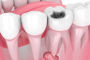 Illustration of decayed or infected tooth, may need to be extracted