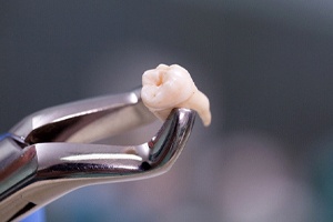 Close-up of extracted tooth gripped in dental forceps