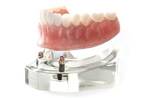 Model of dental implant denture