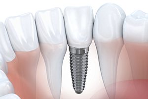 Animated dental implant supported dental crown