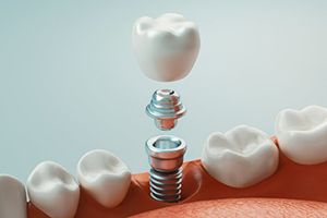 dental implant, abutment, and crown being placed in the lower jaw
