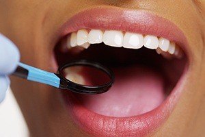Closeup of flawlessly repaired smile after tooth-colored fillings