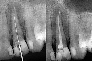 X-rays of root canal treated teeth