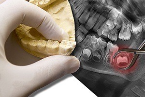 Model and x-rays of teeth to be extracted