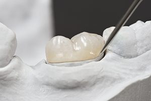 Model tooth with onlay restoration