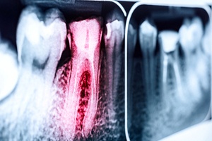 Tooth in need of root canal therapy in West Monroe