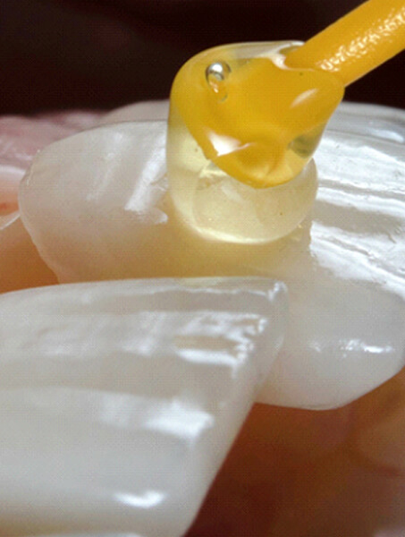 veneers being adhered to the front of prepared teeth