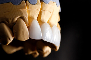 a plaster model of a mouth with veneers attached to the teeth