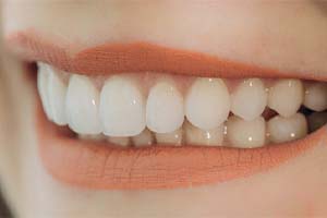 Closeup of woman smiling with veneers in West Monroe