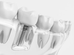 Dental implant graphic 