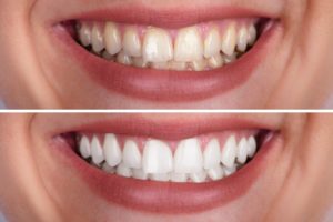 before and after teeth whitening