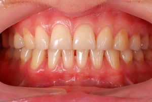 A picture of healthy gums.