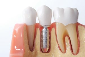 Model of dental implants