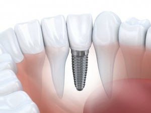 Dental implants can change your life.