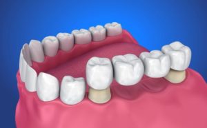 graphic showing typical dental bridge