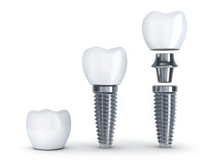 Implants from your dentist in West Monroe can secure dentures