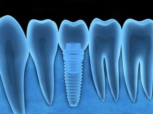 Wondering how you can get the most of your dental implants? Schedule a consultation with your premier dentist in West Monroe, Dr. L. King Scott. 