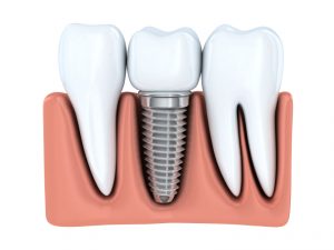 Emplaced dental Implant